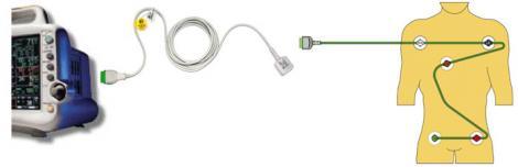 Кабель для подключения одноразовых ЭКГ-электродов ("one-line")